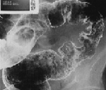 Рентгеноскопия: признаки ишемического колита сигмовидной кишки при двойном контрастировании.