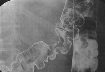 Рентгеноскопия: дефект наполнения, имеющий неровные края – изъязвленная опухоль поперечной ободочной кишки