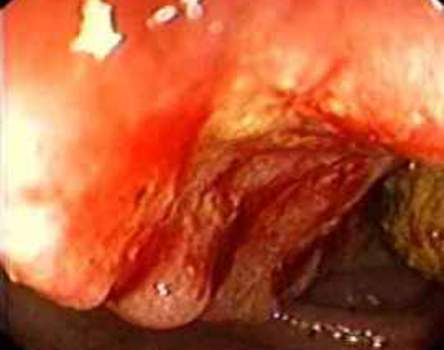 Колоноскопия: картина инфильтративного рака ободочной кишки
