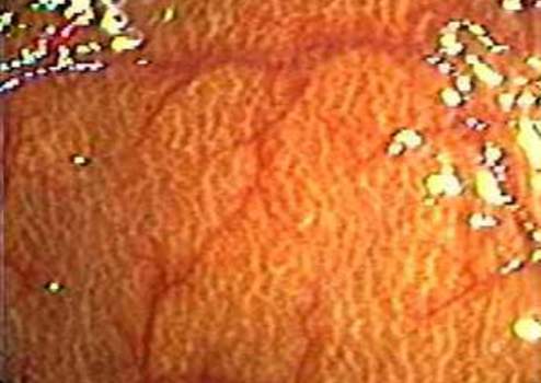 Колоноскопия: меланоз слизистой оболочки ободочной кишки.