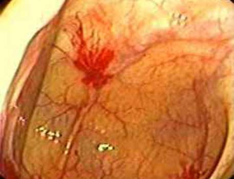 Колоноскопия: ангиодисплазия в слепой кишке