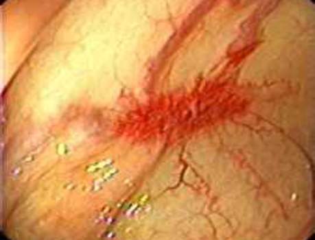 Колоноскопия: ангиодисплазия в восходящей ободочной кишке.