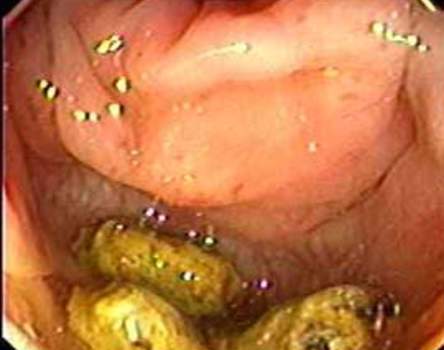 Колоноскопия: признаки воспаления слизистой оболочки вокруг дивертикула сигмовидной кишки