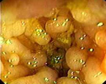 Колоноскопия: полиповидные образования слизистой оболочки толстой кишки