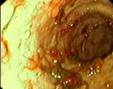 Колоноскопия: полиповидные разрастания – признак воспаления слизистой оболочки
