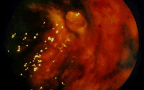 Колоноскопия: «сторожевой бугорок» – псевдополип рядом с дефектом стенки ободочной кишки