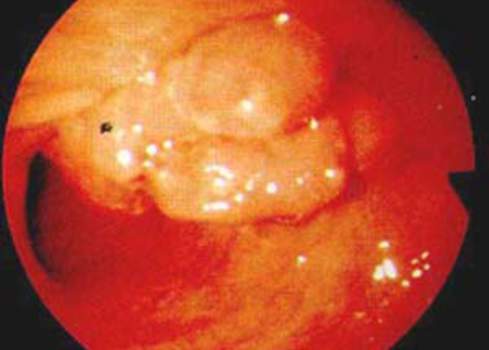 Колоноскопия: распластанная ворсинчатая опухоль толстой кишки
