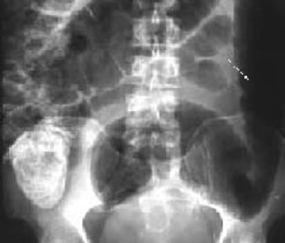 Рентгеноскопия: токсический мегаколон. Вздутая нисходящая кишка (указана стрелкой), гаустры отсутствуют.