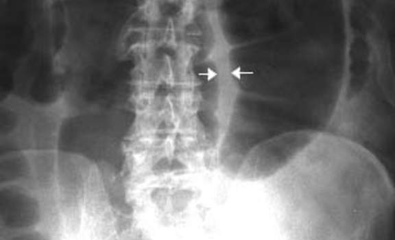 Рентгеноскопия: раздутая сигмовидная кишка. Картина «кофейного зерна» – две петли с расположенной между ними двойной кишечной стенкой (указана стрелкой)