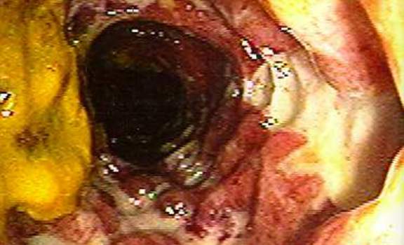 Колоноскопия: глубокие язвы поперечной ободочной кишки у пациента, страдающего болезнью Крона