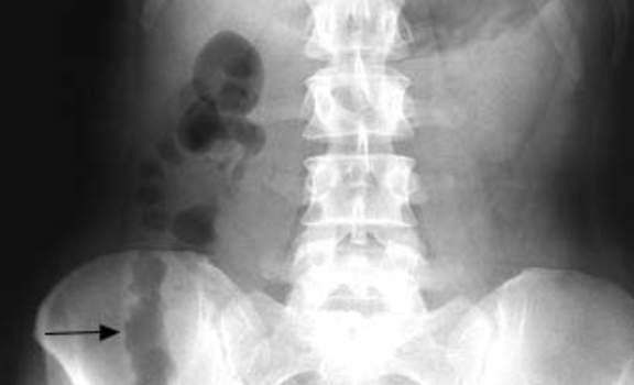 Рентгеноскопия: утолщение стенки слепой кишки и заполнение газом кишечных петель в правом нижнем квадранте.