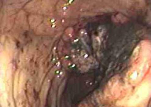 Колоноскопия: распадающаяся опухоль ободочной кишки