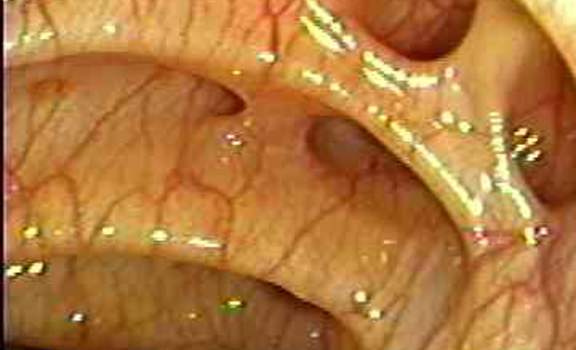 Колоноскопия: множественные дивертикулы сигмовидной кишки.