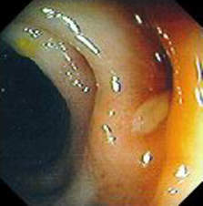 Колоноскопия: дивертикулит. Выделение слизисто-гнойного экссудата из воспаленного дивертикула.