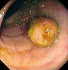 Колоноскопия: полип толстой кишки, при гистологическом исследовании которого был выявлена аденокарцинома