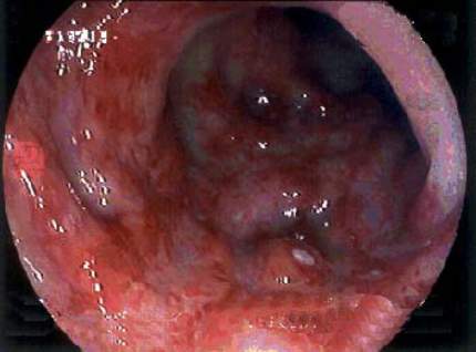 Колоноскопия: язвенный ректоколит у ВИЧ-инфицированного больного. Имеется глубокая язва (в середине изображения) и общая склонность к образованию язв и папул.