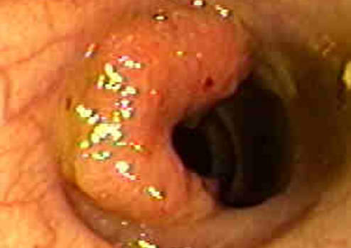 Колоноскопия: блюдцеобразный рак ободочной кишки у пациента, страдающего язвенным колитом