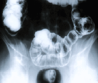 Рентгеноскопия:вид неизмененной толстой кишки, заполненной контрастным веществом.
