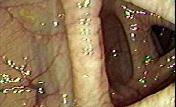 Колоноскопия: вид неизмененной слизистой оболочки поперечной ободочной кишки.