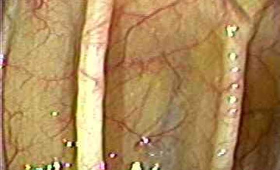 Колоноскопия: складки поперечной ободочной кишки.