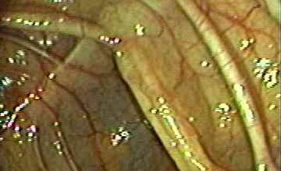 Колоноскопия: сосудистый рисунок неизмененной слизистой оболочки поперечной ободочной кишки.