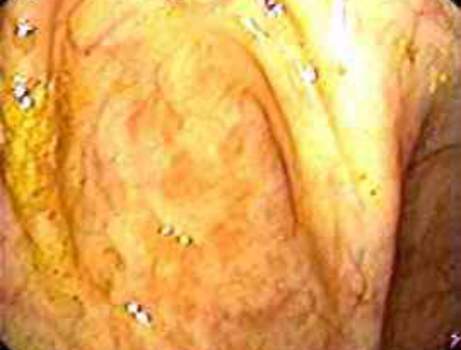 Колоноскопия: Щелевидная форма просвета аппендикса – осмотр со стороны слепой кишки. фото 1.