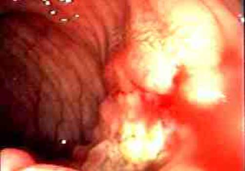 Колоноскопия: инфильтративная опухоль, суживающая просвет ободочной кишки