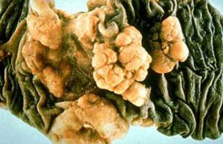 Аденокацинома толстой кишки: плотное полиповидное новообразование, имеющее типичный вид опухоли, возникающей в восходящей ободочной кишке (макропрепарат)