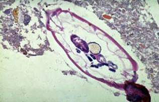 Гельминт в червеобразном отростке, микропрепарат