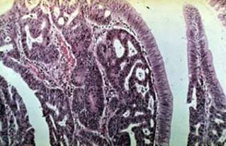 Тубулярно-ворсинчатая аденома толстой кишки: умеренная дисплазия эпителия крипт (микропрепарат)