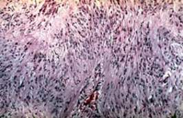 Неврома толстой кишки (микропрепарат)