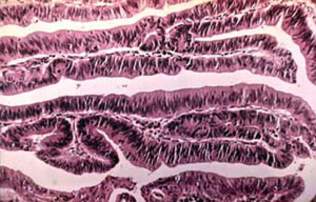 Ворсинчатая аденома толстой кишки: пальцевидные выросты (микропрепарат)
