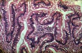 Ворсинчатая аденома толстой кишки: значительная дисплазия эпителия крипт (микропрепарат)