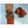 Рак толстой кишки с метастатическим поражением лимфоузлов в области бифуркации трахеи (справа) (макропрепарат)