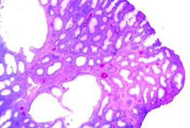 Диффузный полипоз толстой кишки: железистый полип; (микропрепарат). фото 1.