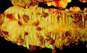 Диффузный полипоз толстой кишки: крупные полипы с дольчатой и ворсинчатой поверхностью (макропрепарат)
