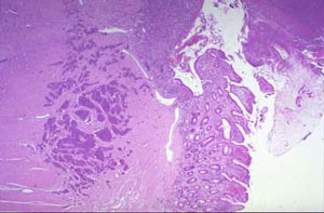 Карциноидная опухоль: «сдержанная», тем не менее,  не инкапсулирована, представлена скоплением многочисленных гнезд небольших голубых клеток в подслизистой оболочке (микропрепарат)
