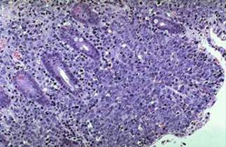 Неходжкинская лимфома: голубые крупные клетки инфильтрируют всю толщу слизистой оболочки (микропрепарат)