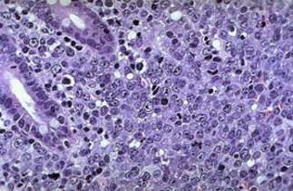 Неходжкинская лимфома: клетки с хорошо заметным глыбками хроматина и ядрами с редкими митотическими фигурами (микропрепарат)