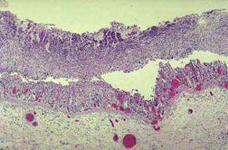 Пседвомембранозный колит: псевдомембраны образованы воспалительными клетками, некротизированным эпителием и слизью, в подслизистой оболочке - расширенные сосуды (микропрепарат)