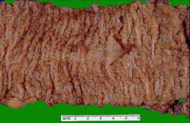 Диффузный полипоз толстой кишки: поверхность слизистой практически полностью усеяна мелкими полипами с ровной или дольчатой поверхностью (макропрепарат)