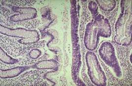 Микроскопическое сравнение нормальной слизистой оболочки толстой кишки слева с железистым полипом (тубуллярной аденомой) справа: железы новообразования нерегулярны с темными, гиперхромными ядрами  (микропрепарат)