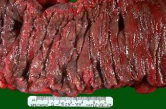 Дивертикулит толстой кишки: поверхность кишки гиперемирована вследствие воспаления (макропрепарат)