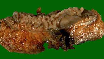 Дивертикул толстой кишки, перфорированный наружу, в результате воспаления, представлен темно-коричневым неправильной формы участком (макропрепарат)