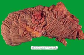 Аденокарцинома, возникшая в ворсинчатой аденоме сигмовидной кишки: поверхность полиповидного новообразования рыжевато-розового цвета (макропрепарат)