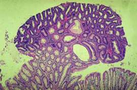 Небольшой аденоматозный полип (тубулярная аденома): большинство желез сдавлено и дезорганизовано по сравнению с нормальной слизистой (микропрепарат)