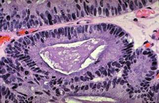 Аденокарцинома толстой кишки: стесненные клетки эпителия неопластической железы с гиперхроматизмом и плеоморфизмом ядер (микропрепарат)
