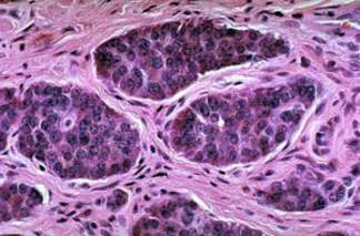 Карциноид толстой кишки:  гнездные скопления имеют типичный внешний вид эндокринных, маленьких округлых клеток с круглым ядром и розоватой или бледно-голубой цитоплазмой (микропрепарат)