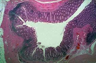 Дивертикул толстой кишки с центрально расположенным просветом, и окружающей слизистой оболочкой, простирающийся через истонченную (лишенную мышечной пластинки) стенку (микропрепарат)
