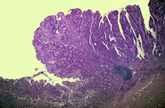 Аденокарцинома, возникшая в ворсинчатой аденоме толстой кишки: железы длинные, подобные листьям папоротника (микропрепарат)